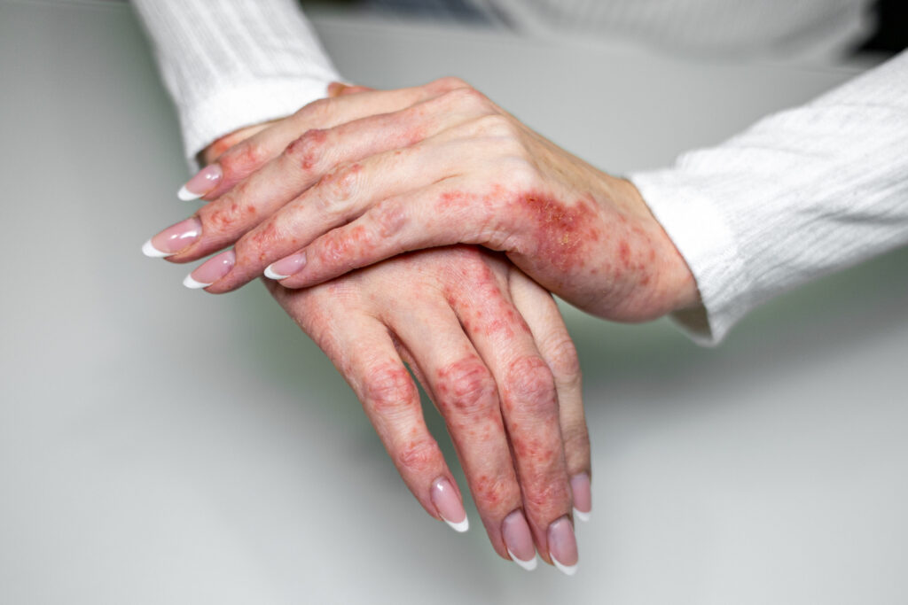 Neurodermitis Hände, Ekzem Neurodermitis Haende Hautausschlag Juckreiz Edited 1024x683